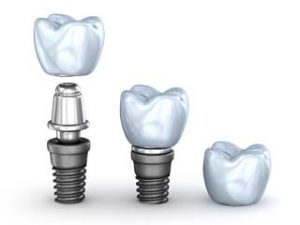 Dental Implants in Ridgefield CT